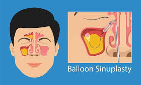 Is Balloon Sinuplasty Worth It Compared to FESS for Severe Sinus Conditions?